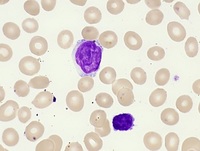 Sezary Cell