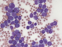 Microgranular APL variant