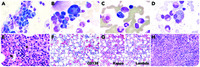 Idiopathic plasmacytic lymphadenopathy with polyclonal hypergammaglobinemia mimicking plasma cell myeloma