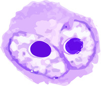 Reed-Sternberg cell