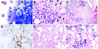 Plasma cell myeloma in a patient with Gaucher disease