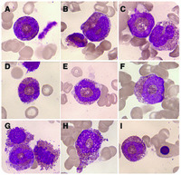 Eosinophils with ring-shaped nuclei in a patient treated with adalimumab