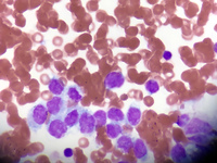 Alveolar Rhabdomiosarcoma Myelophthisis 4