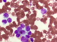 Alveolar Rhabdomiosarcoma Myelophthisis 5