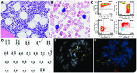 Relapsed NPM1 mutated acute myeloid leukemia with PDGFRA rearrangement