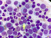 Acute Myeloid Leukemia with Myelodysplasia Related Changes