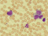 Acute monocytic leukemia 1