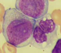 Acute monocytic leukemia 2