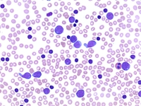 DLBCL variant of Richter Transformation in CLL 2