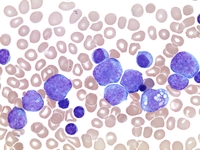 DLBCL variant of Richter Transformation in CLL 3