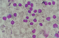 Chronic lymphocytic leukemia (CLL) with presence of pro-lymphocytes 2