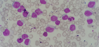 Chronic lymphocytic leukemia (CLL) with presence of pro-lymphocytes 3