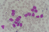 Chronic lymphocytic leukemia (CLL) with presence of pro-lymphocytes 4