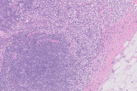 Lymph node with metastatic breast carcinoma