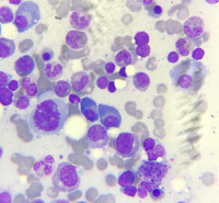 Multiple Myeloma-bone marrow 2