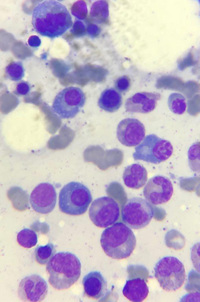 Multiple Myeloma-bone marrow 4