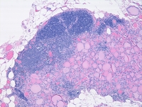 Cervical thymic remnant and intermixed ectopic thyroid tissue H&E