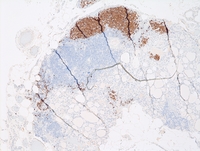 Cervical thymic remnant and intermixed ectopic thyroid tissue TDT