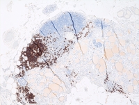 Cervical thymic remnant and intermixed ectopic thyroid tissue CD20