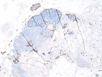 Cervical thymic remnant and intermixed ectopic thyroid tissue P63