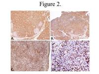 Systemic EBV+ T-cell Lymphoma: CD2, CD3, CD7, & CD5