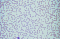 Dapsone induced hemolysis