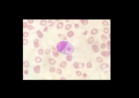 Platelet phagocytosis by a peripheral blood monocyte in a patient with haemophagocytic lymphohistiocytosis