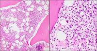 HCL: Bone marrow H&E