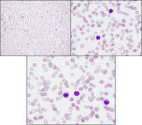 HCL: Peripheral blood