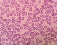 Stomatocytosis in peripheral blood smear 1