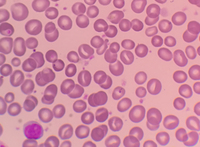 Stomatocytosis in peripheral blood smear 2