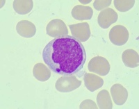 Bone marrow aspirate, MGG X1000 1