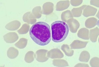 Bone marrow aspirate, MGG X1000 2