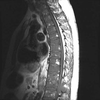 MRI myeloma