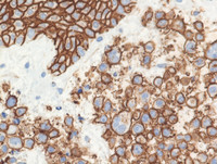 Myeloma-CD138 stain