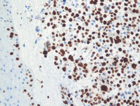 Cutaneous myeloma-Ki-67