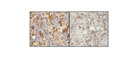 Immunohistochemistry for CD20 and CD 10 on destained bone marrow imprintsImmunohistochemistry for CD20 and CD 10 on destained bone marrow imprints