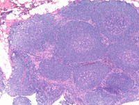 Mantle cell lymphoma with mantle zone pattern-1