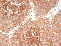 Mantle cell lymphoma with mantle zone pattern-4