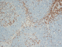 Mantle cell lymphoma with mantle zone pattern-6