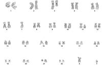 AML with recurrent t(3;3)