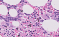 AML with recurrent t(3;3)