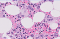 AML with recurrent t(3;3)