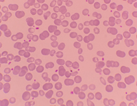 Dimorphic anemia presentation in patient with iron deficiency 3