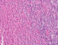 Abundant eosinophils