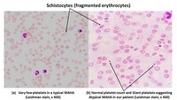 Atypical Microangiopathic Hemolytic Anemia: Case report