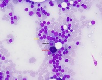 Lymphoplasmacytic Lymphoma