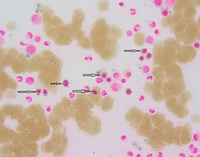 Iron stain showing multiple ring sideroblasts (black arrows) seen on 100x