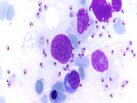 Circulating megakaryocytes in a case of Visceral Leishmaniasis 2