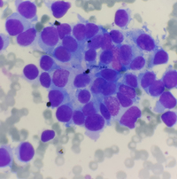 Metastatic Neuroblastoma Aspirate Smear High Power